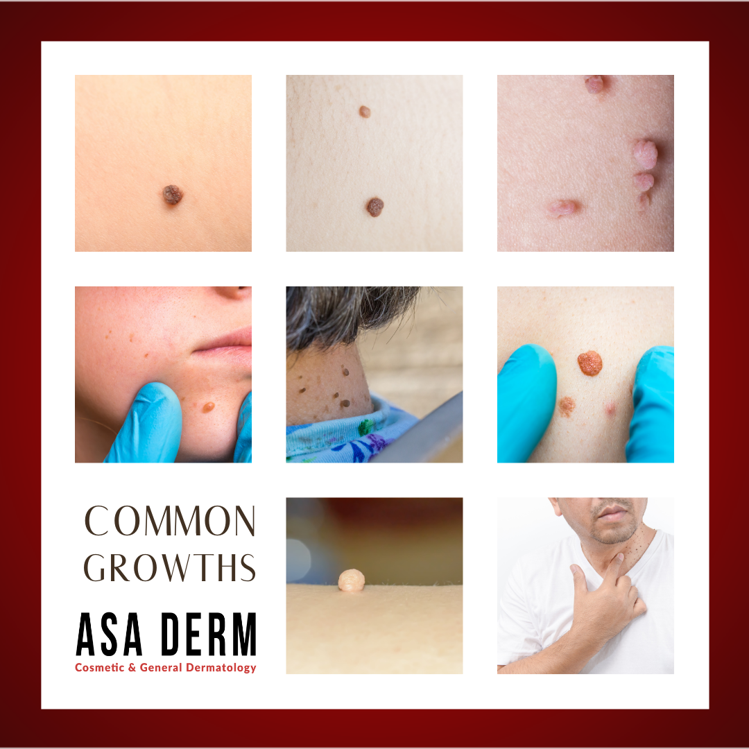 How Are Common Growths Treated Asa Dermatology Allentown Lehigh Valley 8413